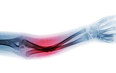 Effect of Long-Term Exposure to Fluoride in Drinking Water on Risks of Bone Fractures