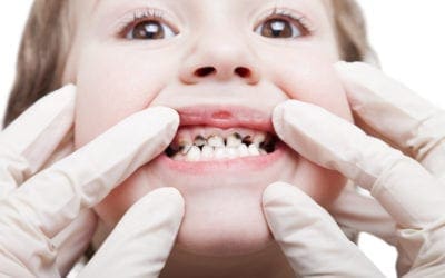 Associations of Community Water Fluoridation with Caries Prevalence and Oral Health Inequality in Children